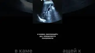 #аденомиоматоз #узи #армдиассистент