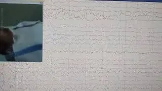 epileptiform discharges saat hipervsntilasi