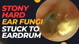 STONY Hard Ear Fungi Stuck To Eardrum