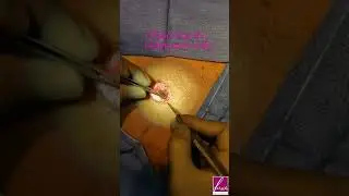 Umbilicoplasty to correct small and overly deep bellybutton after abdominoplasty