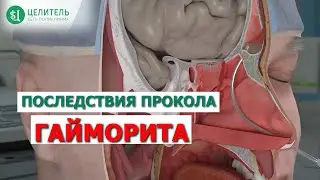 Sinus puncture. What will happen to the bone tissue? Otolaryngologist Kurban Timurovich Magomedov.