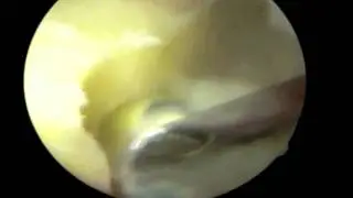Os Acetabuli