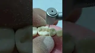 ازاله تسوس كلاس ٢_ Class II amalgam preparation