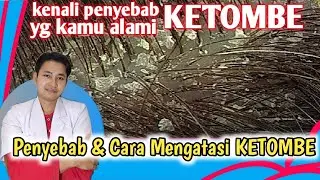 Penyebab & Cara Mengatasi KETOMBE Yang Berkerak dan Gatal Pada Kulit Kepala || dr. Andi Septiawan