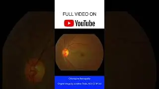 Chloroquine Retinopathy Fundoscopy