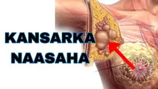 waxaa jira Dad u nugul kansarka naasaha ||Allah ha inaga xifdiyo ||Dr.husen abshir baando