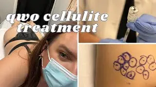 My Qwo Experience // Qwo Cellulite Treatment Before and After // Qwo Bruising & Recovery