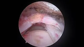 R Rotator Cuff Repair with Arthrex Corkscrew 8.1.22 DS