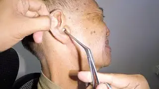 Something Stuck In Elderly Man's Ear Finally Removed After 2 Years | Guess What