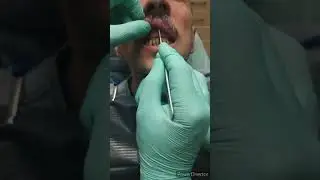 Съёмные протезы.