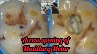 Access opening of Maxillary Molar step by step demonstration # rct for beginners # dental lectures