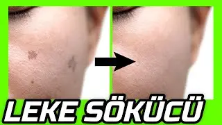 SADECE EVDEKİ MALZEMELERLE YÜZDEKİ LEKELERİ YOK EDEN MUCİZE TARİF Derin Leke Sökücü │ Güzellik Bakım