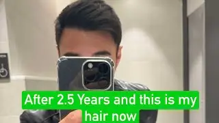2.5 YEARS POST Hair transplant PROCEDURE Update - Motion Hair Clinic, Gangnam
