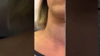 Jugular Vein Distention | MedBridge