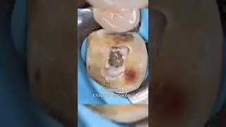 Перелечиваем корневые каналы 
