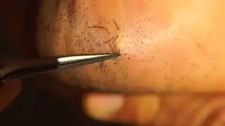 Hair removal asmr pull out with Tweezers  Satisfying pull out beard 10min 202406