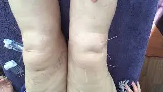 How Shortened and weak muscles cause X knees