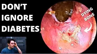 Don't Ignore Diabetes (Complications During Earwax Removal)