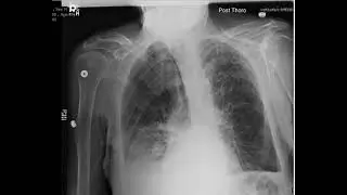 CXR pleural effusion pre and post thoracentesis