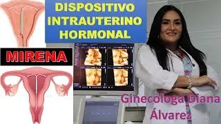 DISPOSITIVO INTRAUTERINO HORMONAL, por GINECOLOGA DIANA ALVAREZ
