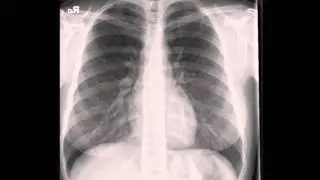 Normal Chest X ray