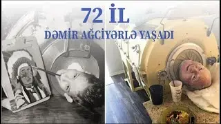 72 il Dəmir ağciyərlə yaşadı... | Doktor men