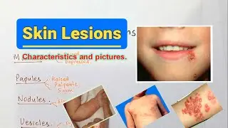 Spider On The Skin(Spider Nevi) Do you want to know about different spots on the skin? Skin Lesions
