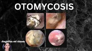 247.Otomycosis ; Fungus in ear #surgeryeducation