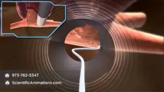 Pacing nContact - Cardiac Animation