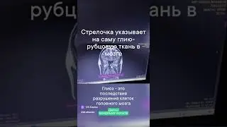 Глиоз- как он выглядит на МРТ