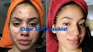 Blackhead Battle Plan: Clear Your Skin & Boost Confidence!