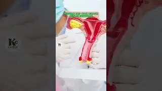 Penyebab Haid Tidak Teratur Setelah Keguguran 