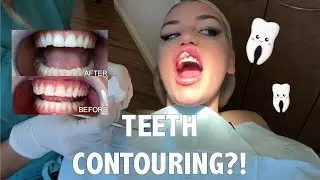 I got my teeth CONTOURED??
