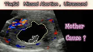 11w, 6d Missed Abortion Ultrasound - what is Mother Cause for Miscarriage ?
