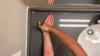 Forearm Laceration OT - Day 1