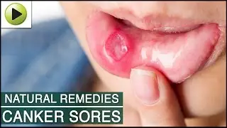 Canker Sores - Natural Ayurvedic Home Remedies