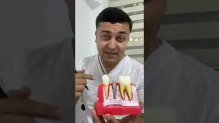 Имплант
