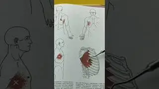 БОЛЬ В ГРУДНОЙ КЛЕТКЕ, МЕЖРЕБЕРНАЯ НЕВРАЛГИЯ, ПЕРЕРЕДНЯЯ ЗУБЧАТАЯ МЫШЦА ТРИГГЕРНЫЕ ТОЧКИ