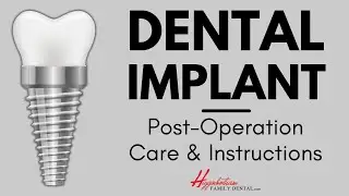 What To Do After Getting a Dental Implant | #experienceHFD