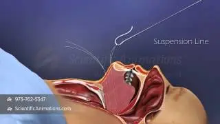 Sleep Apnea Treatment