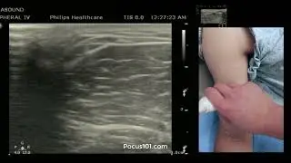 Mapping out Brachial, Cephalic, and Basilic Veins