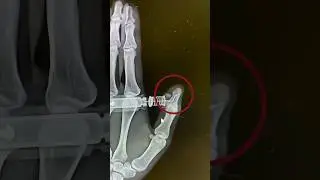EpiPen Gone Wrong 😨