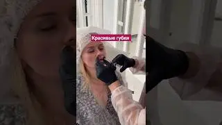 Коррекция формы губ филлерами.