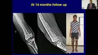 Massive Soft Tissue  Bone Defects in the lower limb Dr Hari Venkatramani Ganga Ram Hospital Coimbato