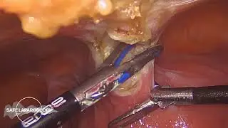 Subtotal hysterectomy due to adenomyosis