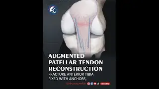COMPLEX KNEE INJURY  (STAGE-I PERFORMED) EDUCATIONAL VIDEO
