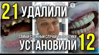 Самый сложный случай из практики. Имплантация зубов.