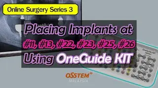 Placing Implants at #11, #13, #22, #23, #25, #26 Using OneGuide KIT