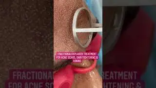 FractionalCO2laser Treatment for Acne Scars| Dermatologist|Skin tightening | Chandigarh 