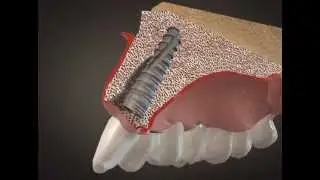 Implante dental, animación 3D.